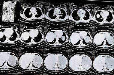 Kahire, Mısır, 3 Ekim 2023: Çoklu kesit CT taraması karın ve pelvis sağ yumurtalık kisti 3 x 3 cm, kolon gazı şişmesi, geniş çaplı idrar ve taş saptanamadı
