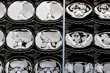 Kahire, Mısır, 3 Ekim 2023: Çoklu kesit CT taraması karın ve pelvis sağ yumurtalık kisti 3 x 3 cm, kolon gazı şişmesi, geniş çaplı idrar ve taş saptanamadı