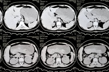 Kahire, Mısır, 3 Ekim 2023: Çoklu kesit CT taraması karın ve pelvis sağ yumurtalık kisti 3 x 3 cm, kolon gazı şişmesi, geniş çaplı idrar ve taş saptanamadı