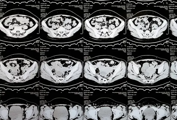 Kahire, Mısır, 3 Ekim 2023: Çoklu kesit CT taraması karın ve pelvis sağ yumurtalık kisti 3 x 3 cm, kolon gazı şişmesi, geniş çaplı idrar ve taş saptanamadı