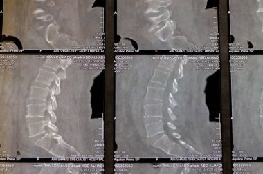 Kahire, Mısır, 15 Ekim 2023: BT taramasında lumbo-sakral omurga kereste spondilotik değişimleri, L4-L5, L5-S1 dağınık disk çıkıntıları, çift taraflı birleşme eklemi, çift taraflı sakro-ilietis