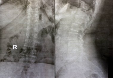 Sırt ve kereste omurgasının röntgen ışınları spondilotik değişimleri, sırt ve kereste dikenlerinin düzleştirilmesini, omurgalar arası disk alanlarının bozulmamış olduğunu, sırt ve kereste dikenlerinin Spondylosis 'inin bozulmamış olduğunu gösterir.