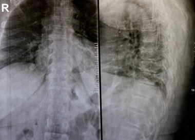 Sırt ve kereste omurgasının röntgen ışınları spondilotik değişimleri, sırt ve kereste dikenlerinin düzleştirilmesini, omurgalar arası disk alanlarının bozulmamış olduğunu, sırt ve kereste dikenlerinin Spondylosis 'inin bozulmamış olduğunu gösterir.