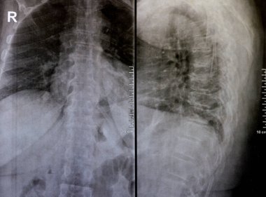 Sırt ve kereste omurgasının röntgen ışınları spondilotik değişimleri, sırt ve kereste dikenlerinin düzleştirilmesini, omurgalar arası disk alanlarının bozulmamış olduğunu, sırt ve kereste dikenlerinin Spondylosis 'inin bozulmamış olduğunu gösterir.