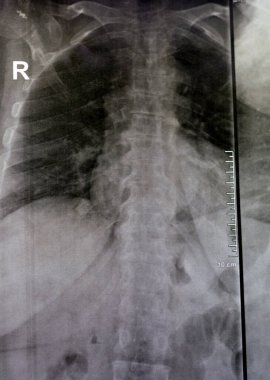 Sırt ve kereste omurgasının röntgen ışınları spondilotik değişimleri, sırt ve kereste dikenlerinin düzleştirilmesini, omurgalar arası disk alanlarının bozulmamış olduğunu, sırt ve kereste dikenlerinin Spondylosis 'inin bozulmamış olduğunu gösterir.