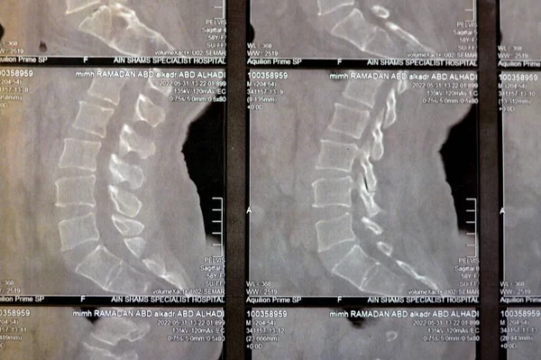 Kahire, Mısır, 15 Ekim 2023: BT taramasında lumbo-sakral omurga kereste spondilotik değişimleri, L4-L5, L5-S1 dağınık disk çıkıntıları, çift taraflı birleşme eklemi, çift taraflı sakro-ilietis