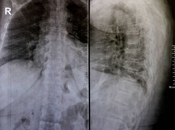 Sırt ve kereste omurgasının röntgen ışınları spondilotik değişimleri, sırt ve kereste dikenlerinin düzleştirilmesini, omurgalar arası disk alanlarının bozulmamış olduğunu, sırt ve kereste dikenlerinin Spondylosis 'inin bozulmamış olduğunu gösterir.
