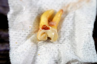 Çıkarılmış bilgelik. 8 'inci diş, diş çürümesi, açığa çıkan sinir ve şiddetli ağrı, şişme ve iltihaplanma sonrası, 20' inci diş azı dişleri, en son ve en uzak arka dişlerdir.
