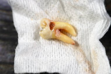 Çıkarılmış bilgelik. 8 'inci diş, diş çürümesi, açığa çıkan sinir ve şiddetli ağrı, şişme ve iltihaplanma sonrası, 20' inci diş azı dişleri, en son ve en uzak arka dişlerdir.