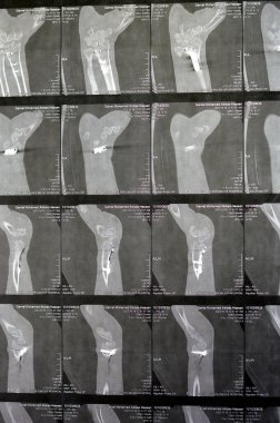 Kahire, Mısır, 18 Ekim 2023: Tomografi sol bilek ekleminde yakın zamanda sol ön kol kemiğinin alt kısmında çatlak olduğunu gösteriyor.