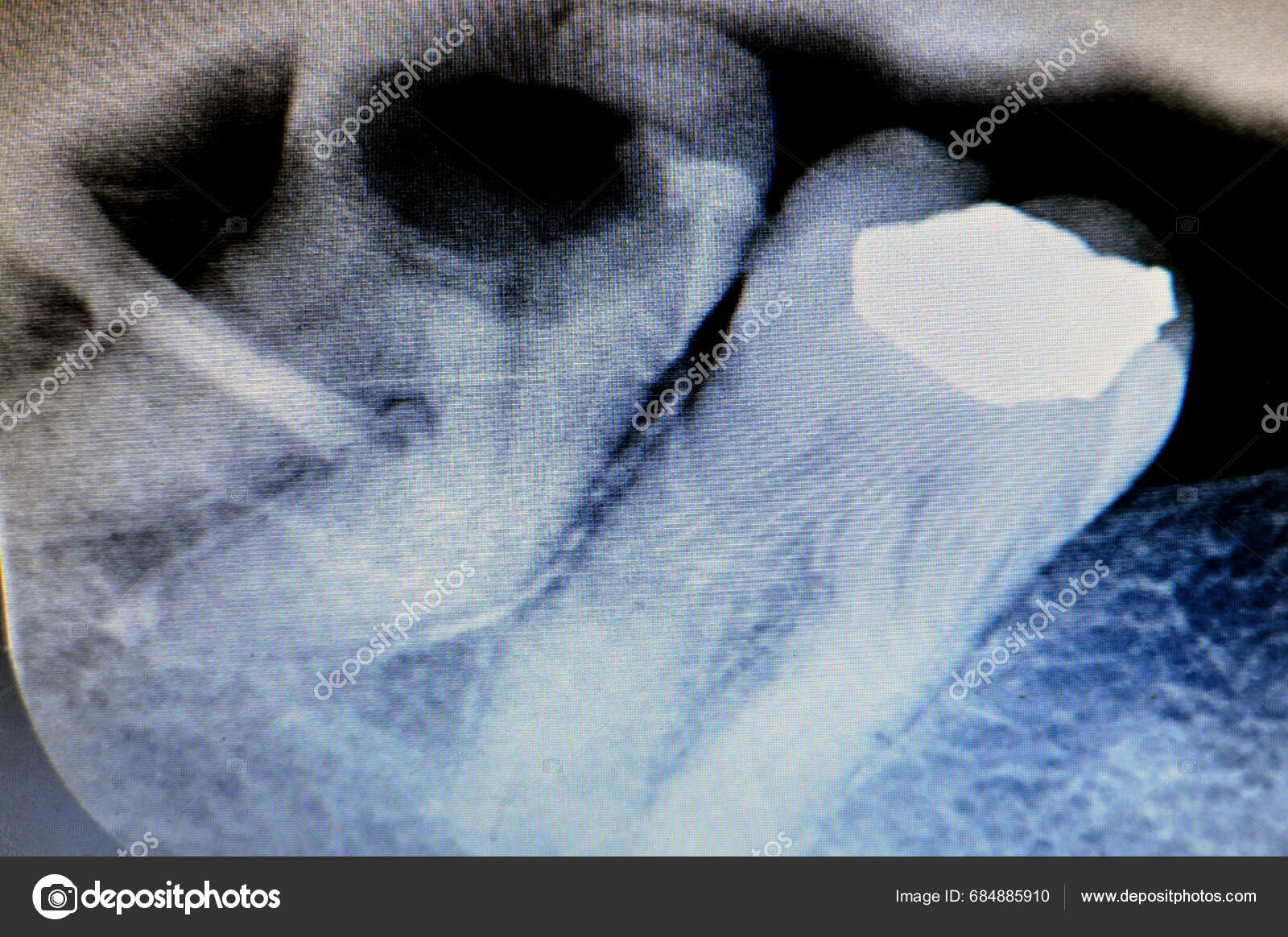 Ray Wisdom 8Th Lower Right Tooth Teeth Decay Exposed Nerve Stock Photo by ©Tamer_Soliman 684885910