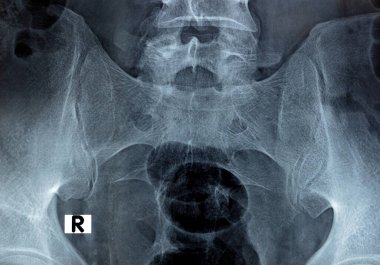 Sacroiliac eklem dijital radyografik inceleme röntgeni, korunmuş sakroiliak eklem boşlukları ve pürüzsüz eklem yüzeyleri, düşük sırt ağrısı konsepti, Sacro iliac eklemleri üzerine seçici röntgen ışını odağı