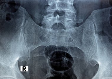 Sacroiliac eklem dijital radyografik inceleme röntgeni, korunmuş sakroiliak eklem boşlukları ve pürüzsüz eklem yüzeyleri, düşük sırt ağrısı konsepti, Sacro iliac eklemleri üzerine seçici röntgen ışını odağı