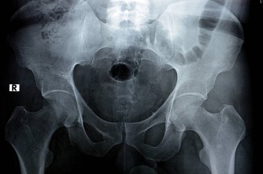 Kalça eklemleri dijital radyografik muayenesi kalça birleşimlerinin, çoklu pelvik flebolinin, çift taraflı coxa profunda 'nın, uyluk kemiğinin korunmuş küresel konumu, seçici odak noktasının normal görünümünü ortaya koyuyor.