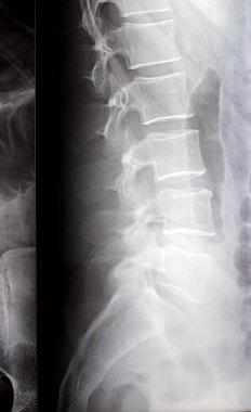 Lumbosacral omurga dijital radyografik muayenesi düz kereste lordotik eğrisi, L4 omurgasının marjinal osteofizik dudak ucu, disk alanlarını ve el değmemiş sakroiliak eklemleri gösteriyor.