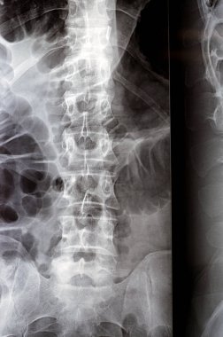 Lumbosacral omurga dijital radyografik muayenesi düz kereste lordotik eğrisi, L4 omurgasının marjinal osteofizik dudak ucu, disk alanlarını ve el değmemiş sakroiliak eklemleri gösteriyor.