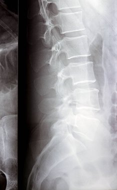 Lumbosacral omurga dijital radyografik muayenesi düz kereste lordotik eğrisi, L4 omurgasının marjinal osteofizik dudak ucu, disk alanlarını ve el değmemiş sakroiliak eklemleri gösteriyor.