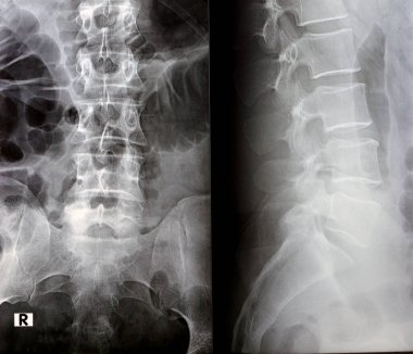 Lumbosacral omurga dijital radyografik muayenesi düz kereste lordotik eğrisi, L4 omurgasının marjinal osteofizik dudak ucu, disk alanlarını ve el değmemiş sakroiliak eklemleri gösteriyor.