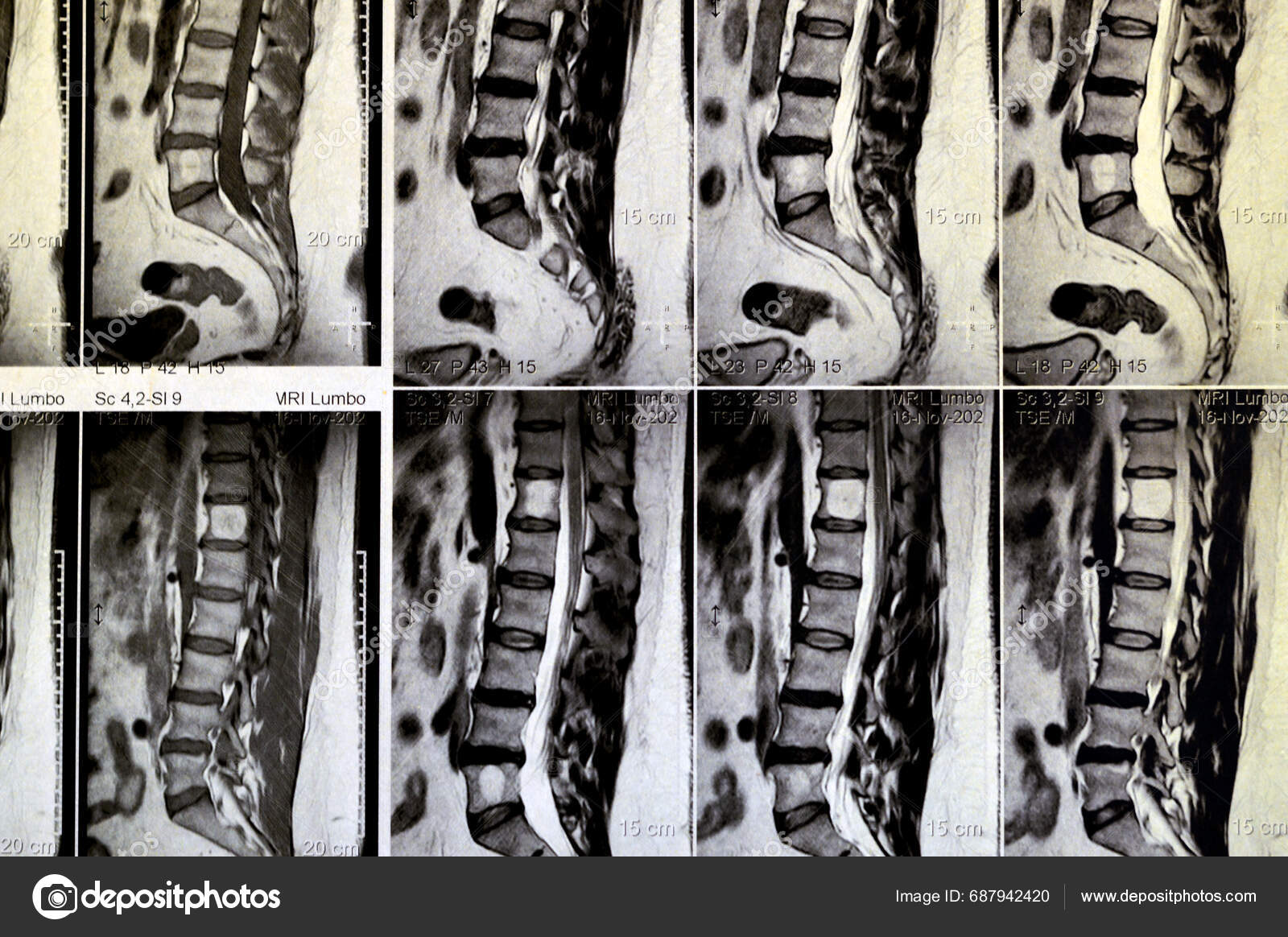 Mri Lumbosacral Spine Contrast Revealed Back Muscle Spasm Mild Disc