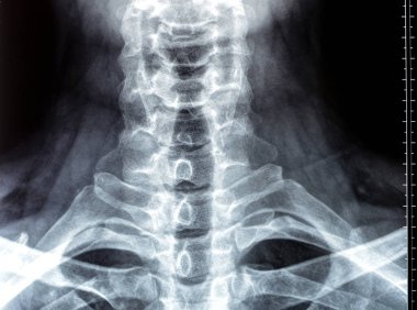 Servikal omurga röntgeni servikal eğrinin düzeldiğini gösterdi. C3, C4, C5 omurgası, dar disk alanları, C4, C5 'e zıt bağsal kireçlenme.