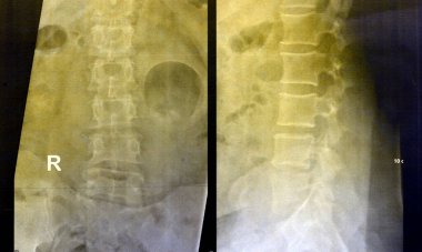 Düz X ışınlı lumbosakral omurga düz, hafif skolyotik deformasyon, spondilotik değişiklikler, çift taraflı Sacroiliit, hafif daralma L4-L5, L5-S1 disk alanı