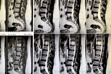 Kontrastsız MRI lumbosakral omurga sırt kası spazmı, L3-L4, L4-L5 disk lezyonları, Sacral, L5 ve T12 omurları heemangiomata, düz kereste eğriliği, seçici odaklanma