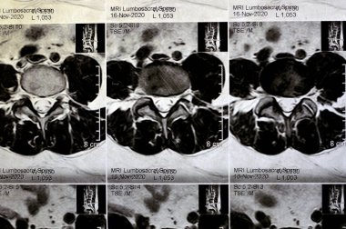 Kontrastsız MRI lumbosakral omurga sırt kası spazmı, L3-L4, L4-L5 disk lezyonları, Sacral, L5 ve T12 omurları heemangiomata, düz kereste eğriliği, seçici odaklanma
