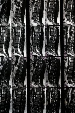 Kahire, Mısır, 14 Kasım 2023: Omurga MR 'ı miospazm, L4-L5, L5-S1 dağınık disk çıkıntısı, L3,4 disk dejenerasyonu, sırt ve kereste hemanjiyomlarının düzeldiğini ortaya çıkardı.