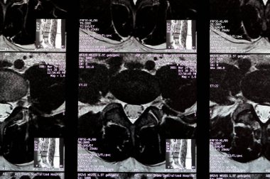 Kahire, Mısır, 14 Kasım 2023: Omurga MR 'ı miospazm, L4-L5, L5-S1 dağınık disk çıkıntısı, L3,4 disk dejenerasyonu, sırt ve kereste hemanjiyomlarının düzeldiğini ortaya çıkardı.