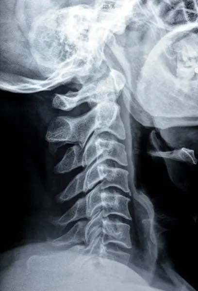Plain X ray of cervical spine revealed straightened cervical curve, spondylosis osteophytic lipping of C3, C4, C5 vertebral end plates, narrow disc spaces, ligamentous calcification opposing C4, C5