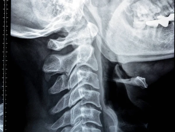 Plain X ray of cervical spine revealed straightened cervical curve, spondylosis osteophytic lipping of C3, C4, C5 vertebral end plates, narrow disc spaces, ligamentous calcification opposing C4, C5