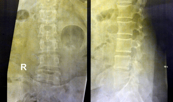Plain X ray lumbosacral spine revealed straightened, mild scoliotic deformity of  lumber spine, spondylotic changes, bilateral Sacroiliitis, mild narrowing of L4-L5, L5- S1 disc spaces