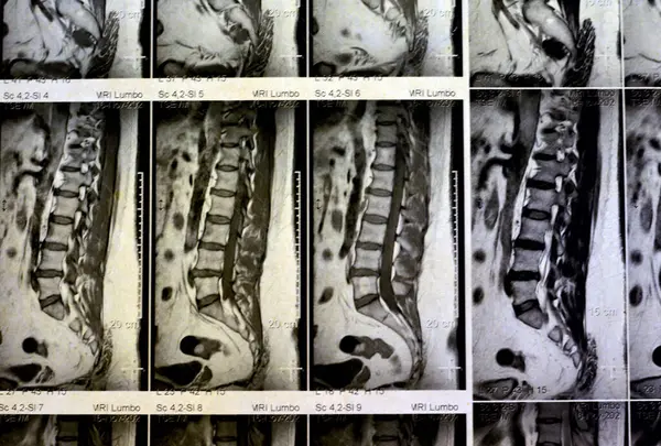 MRI lumbosacral spine without contrast revealed back muscle spasm, Mild L3-L4, L4-L5 disc lesions, Sacral, L5 and T12 vertebral bodies haemangiomata,  straightened lumber curvature, selective focus