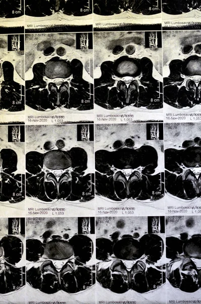 MRI lumbosacral spine without contrast revealed back muscle spasm, Mild L3-L4, L4-L5 disc lesions, Sacral, L5 and T12 vertebral bodies haemangiomata,  straightened lumber curvature, selective focus