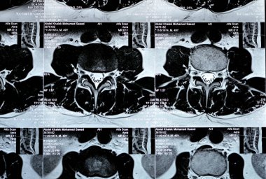Kahire, Mısır, 14 Kasım 2023: L3-L4, L4-L5 posterior disk çıkıntıları, ventral epidural yağ, teta, D12 ve L5 intra-osseous hemangiomata