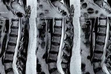 Kahire, Mısır, 14 Kasım 2023: L3-L4, L4-L5 posterior disk çıkıntıları, ventral epidural yağ, teta, D12 ve L5 intra-osseous hemangiomata