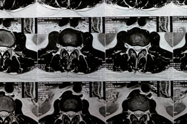 Kahire, Mısır, 14 Kasım 2023: L3-L4, L4-L5 posterior disk çıkıntıları, ventral epidural yağ, teta, D12 ve L5 intra-osseous hemangiomata