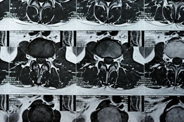 Kahire, Mısır, 14 Kasım 2023: L3-L4, L4-L5 posterior disk çıkıntıları, ventral epidural yağ, teta, D12 ve L5 intra-osseous hemangiomata