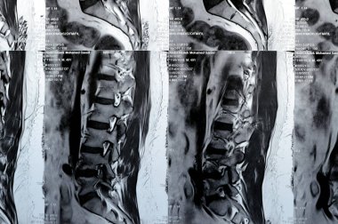 Kahire, Mısır, 14 Kasım 2023: L3-L4, L4-L5 posterior disk çıkıntıları, ventral epidural yağ, teta, D12 ve L5 intra-osseous hemangiomata