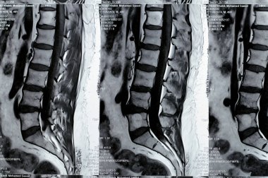 Kahire, Mısır, 14 Kasım 2023: L3-L4, L4-L5 posterior disk çıkıntıları, ventral epidural yağ, teta, D12 ve L5 intra-osseous hemangiomata