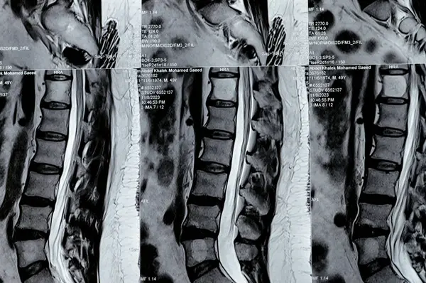 Kahire, Mısır, 14 Kasım 2023: L3-L4, L4-L5 posterior disk çıkıntıları, ventral epidural yağ, teta, D12 ve L5 intra-osseous hemangiomata