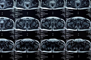 Kahire, Mısır, 21 Kasım 2023: Kalça ekleminin MR 'ı çift taraflı femoral baş avasküler nekrozu, sol uyluk başı, boyun, intertrokanterik bölge, kalça eklem efüzyonu