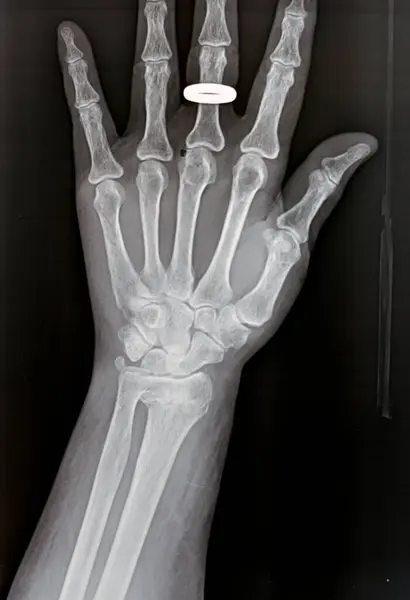 Colles Fracture Old Female Type Fracture Distal Forearm Which Broken — Stock Photo, Image