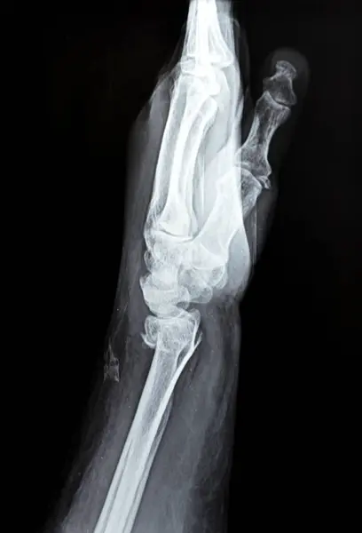 Colles\' fracture of an old female, a type of fracture of the distal forearm in which the broken end of the radius is bent backwards, as a result of a fall on an outstretched hand with osteoporosis