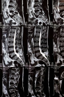 Kahire, Mısır, 24 Aralık 2023: L5 Omurga Spinal laminektomi kanıtı, posterior sac dekompresyon, bel spondilozu, L3-4, L4-5, L5-S1 'in merkezi çıkıntısı