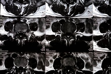 Kahire, Mısır, 24 Aralık 2023: L5 Omurga Spinal laminektomi kanıtı, posterior sac dekompresyon, bel spondilozu, L3-4, L4-5, L5-S1 'in merkezi çıkıntısı