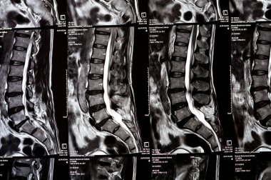 Kahire, Mısır, 24 Aralık 2023: L5 Omurga Spinal laminektomi kanıtı, posterior sac dekompresyon, bel spondilozu, L3-4, L4-5, L5-S1 'in merkezi çıkıntısı