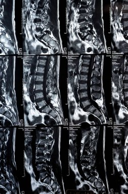 Kahire, Mısır, 24 Aralık 2023: L5 Omurga Spinal laminektomi kanıtı, posterior sac dekompresyon, bel spondilozu, L3-4, L4-5, L5-S1 'in merkezi çıkıntısı