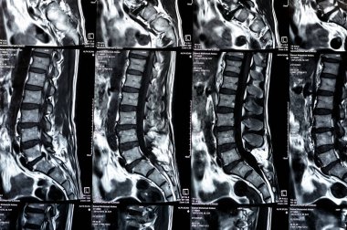 Kahire, Mısır, 24 Aralık 2023: L5 Omurga Spinal laminektomi kanıtı, posterior sac dekompresyon, bel spondilozu, L3-4, L4-5, L5-S1 'in merkezi çıkıntısı