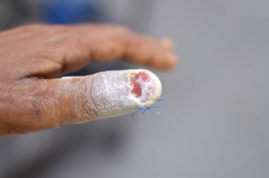 Sol elinin baş parmağı, başparmağının cerrahi müdahaleyle çıkarılması ve parmağa alınan ve çivinin bir kısmının zarar görmesine ve seçici bir şekilde odaklanmasına neden olan doğrudan travmadan sonra kesilen bir yaranın dikişleri.